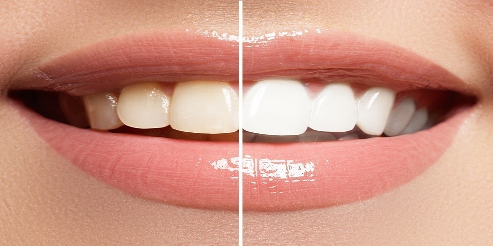 Are Over-the-counter Products Safe for Teeth Whitening?